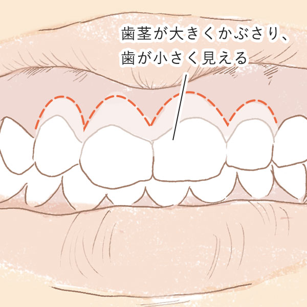 歯茎の問題