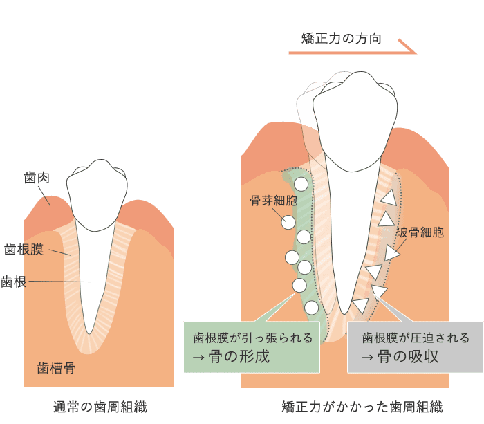 骨代謝を利用した歯の動き