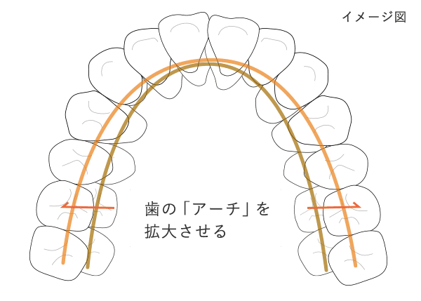 歯列の幅の拡張