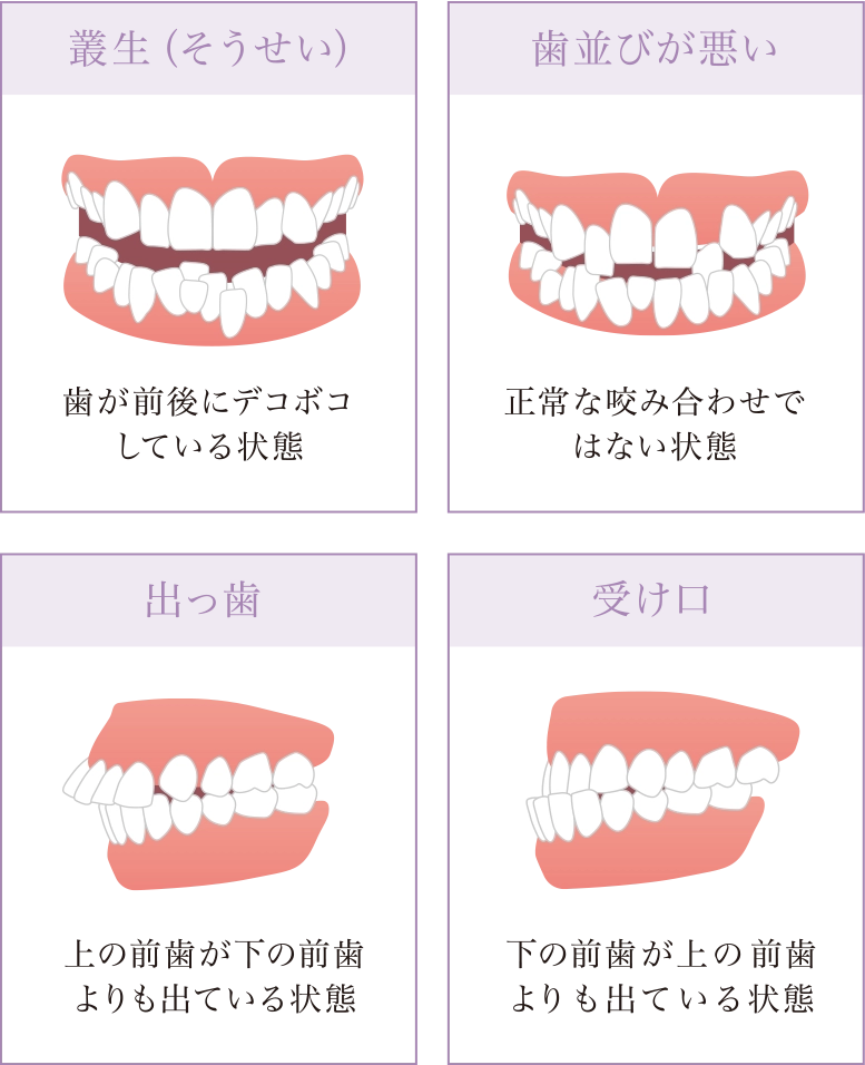 マウスピース型矯正に向いていない主な症状