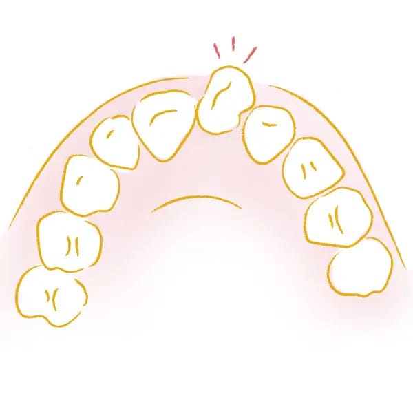 すきっ歯（空隙歯列）