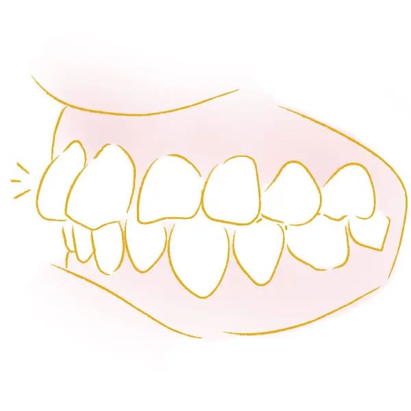 軽度の出っ歯