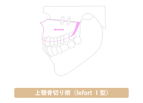 上顎骨切り術（lefort Ⅰ型）