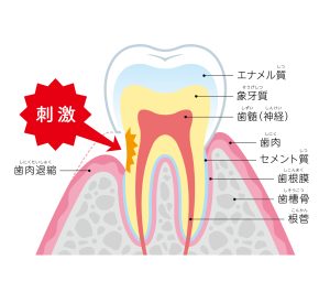 歯列矯正　リスク　歯肉退縮