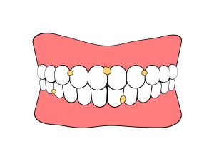 歯垢　歯石