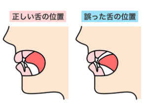舌　舌スポット　低位舌