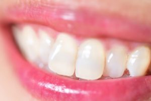 前歯が大きいのは歯列矯正で治せる？