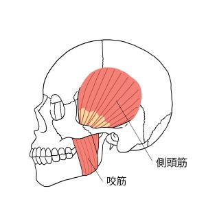 天神　矯正　咬筋