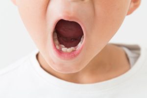 「歯が二列に？」二重歯列の原因や4つの悪影響と治療法