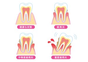 歯並び　歯周病　歯垢