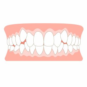八重歯　歯列矯正　犬歯