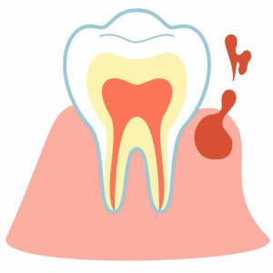 歯周病のサイン　出血　腫れ