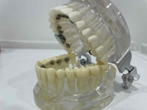 歯列矯正　裏側矯正　八重歯