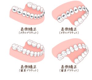 歯列矯正　ワイヤー矯正　種類