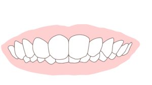 歯列矯正　過蓋咬合　歯並び