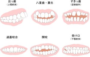 歯列矯正　叢生　種類