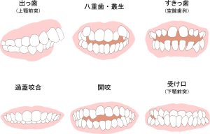 矯正　歯並び　歯列矯正