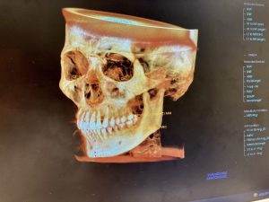 分析ソフト　CTデータ 当院Drのデータ