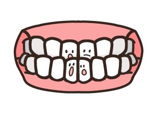 骨格性　歯並び　受け口