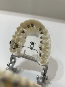 福岡　天神　矯正　アンカースクリュー