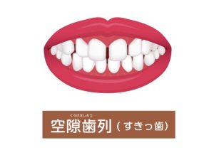 矯正　歯並び　すきっ歯