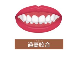 矯正　歯並び　過蓋咬合