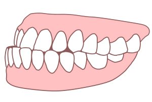 受け口　歯列矯正　特徴