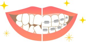 歯列矯正　レベリング　がたつき　改善