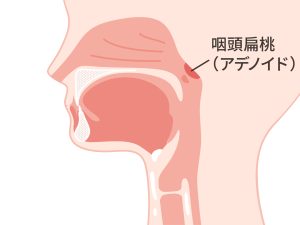 受け口　アデノイド