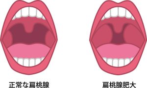 扁桃腺　受け口　原因　腫れ