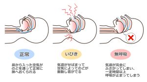 睡眠時無呼吸症候群　原因　歯並び　起動