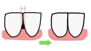 IPR　ディスキング