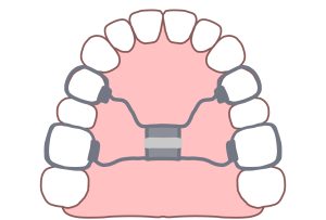 拡大装置　歯列矯正　非抜歯