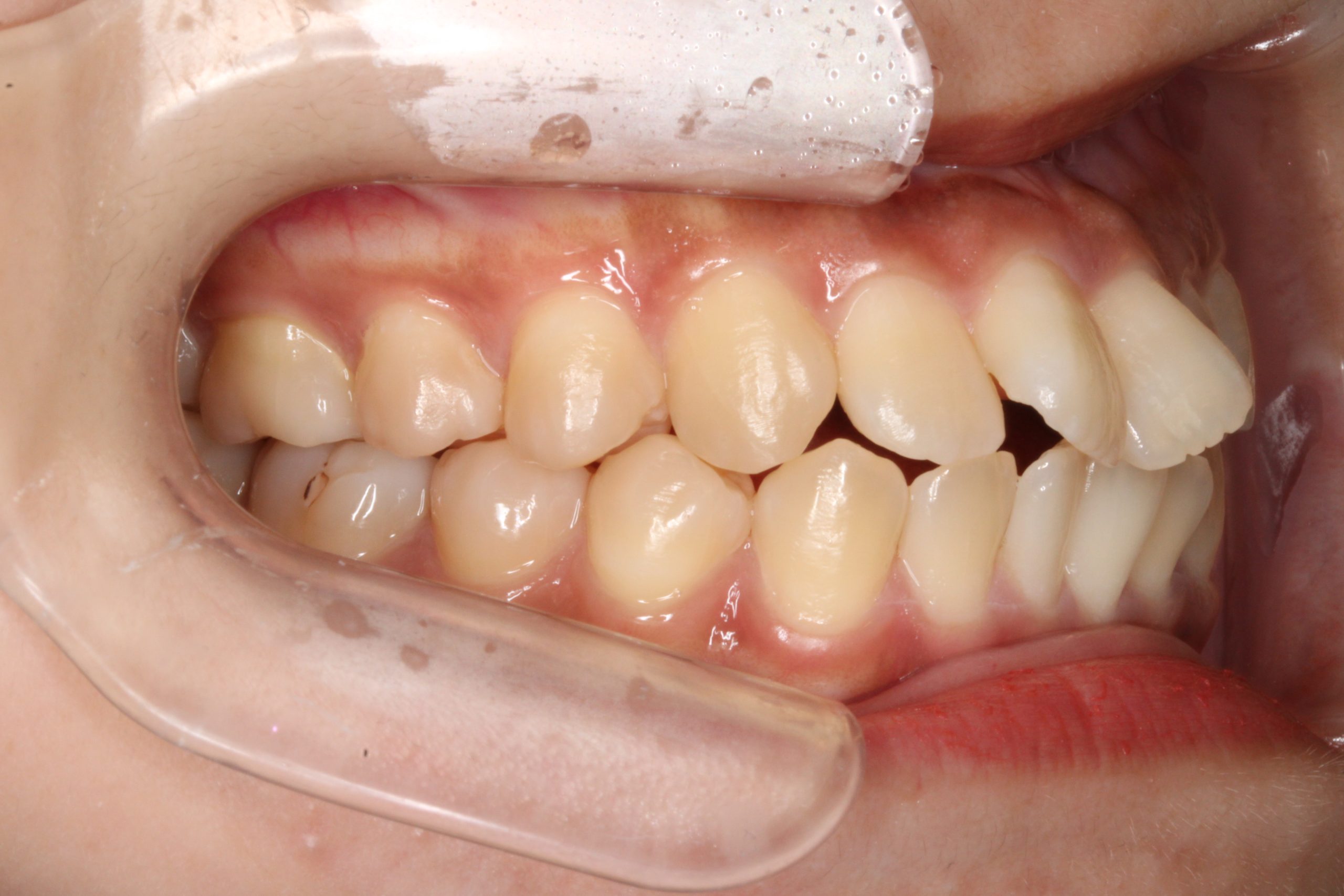 上顎前突・前歯の凸凹・リンガルの症例