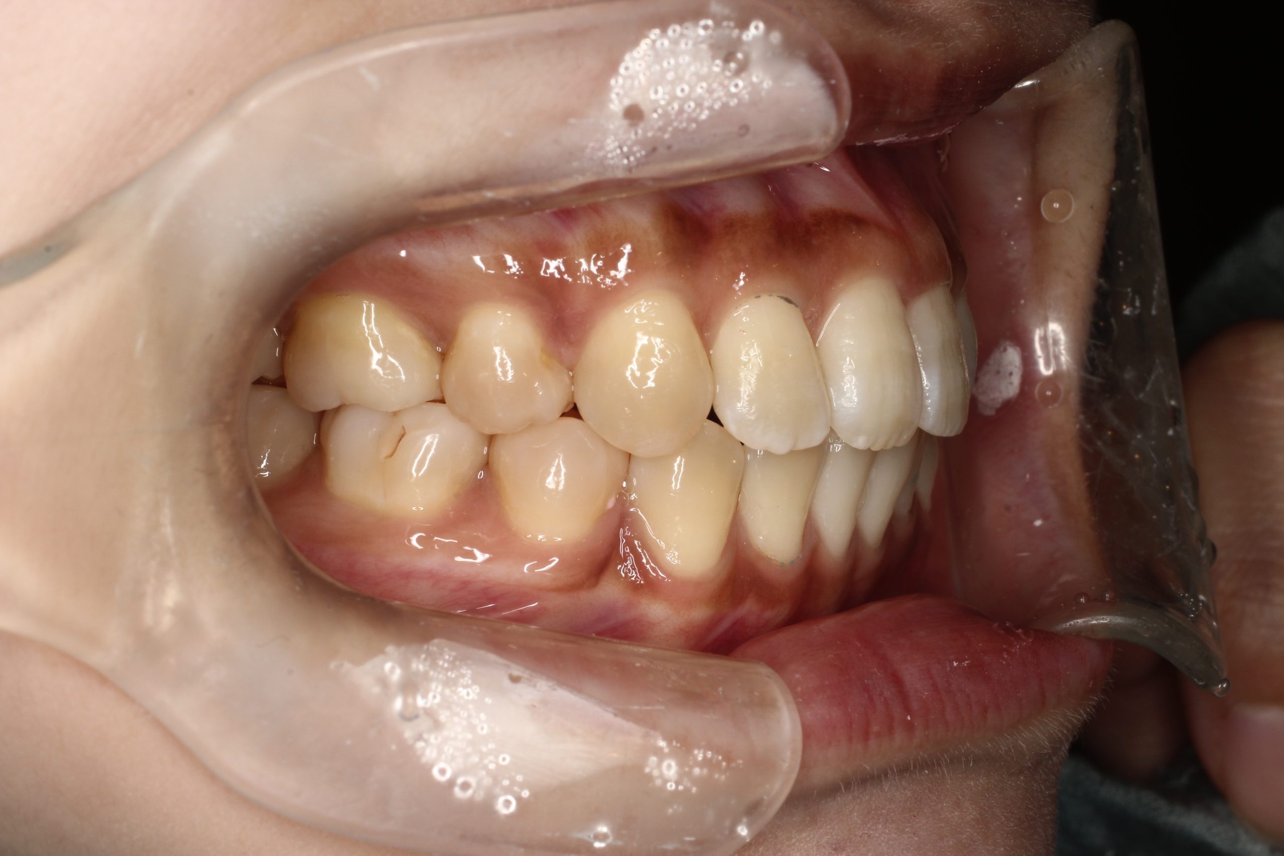 上顎前突・前歯の凸凹・リンガルの症例