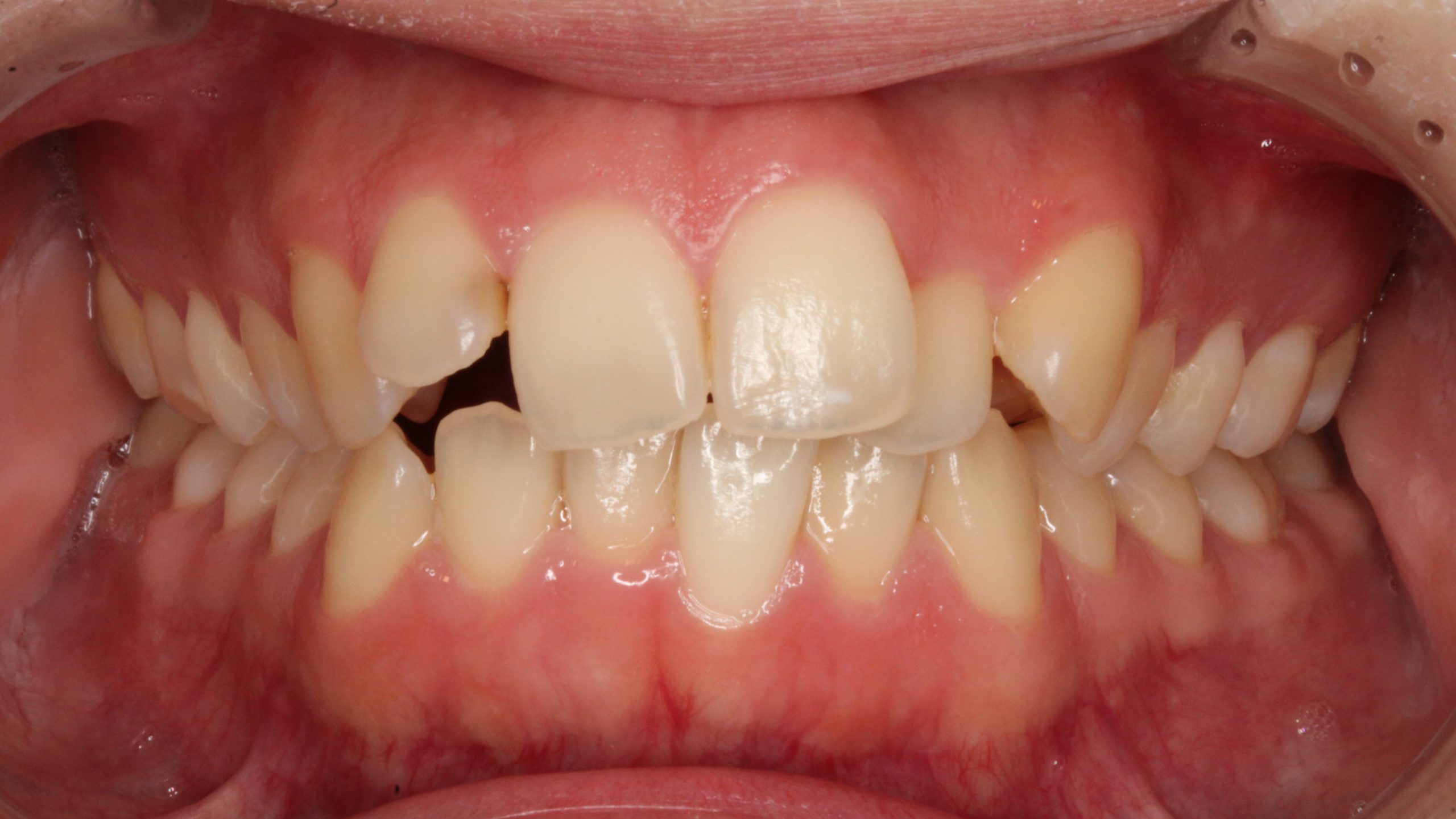 前歯の凸凹・ハーフリンガルの症例