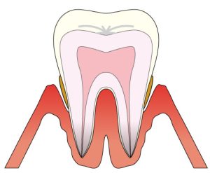 歯周炎　歯周病　