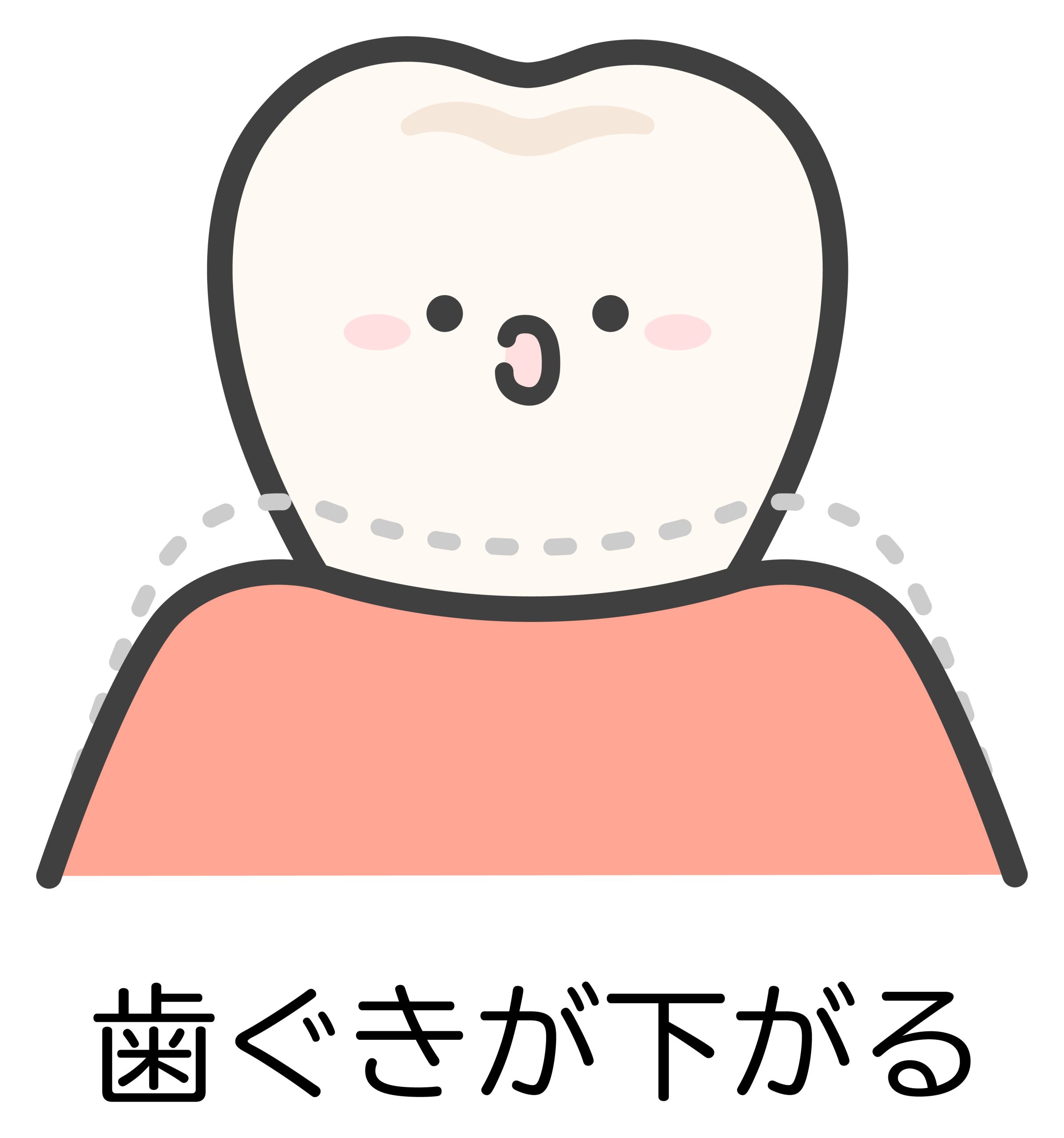 歯肉後退　歯周病　歯茎