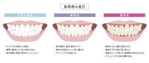 歯周病　歯肉炎　歯並び 