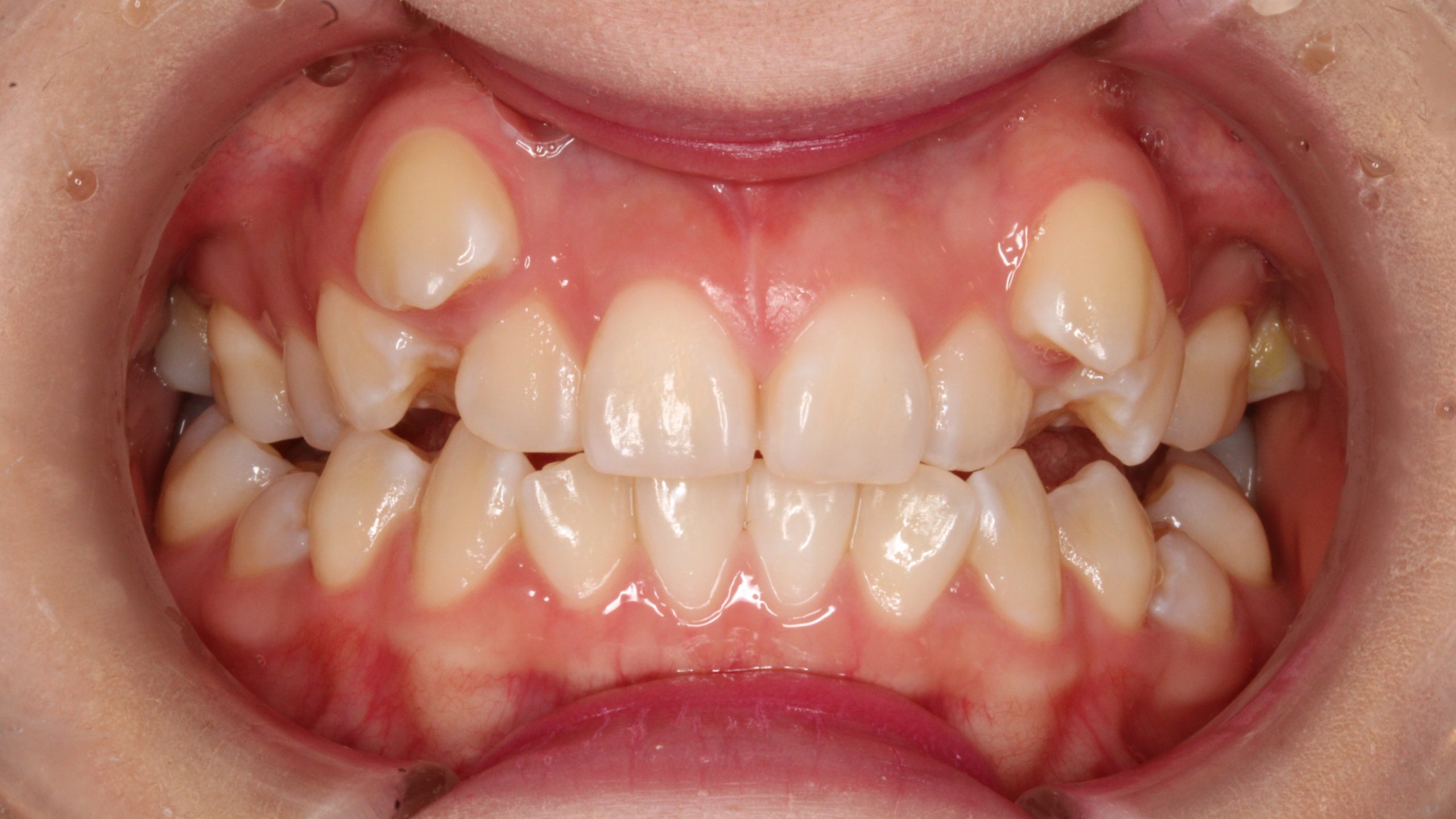 叢生・嚙み合わせ合わない・八重歯・表側矯正の症例