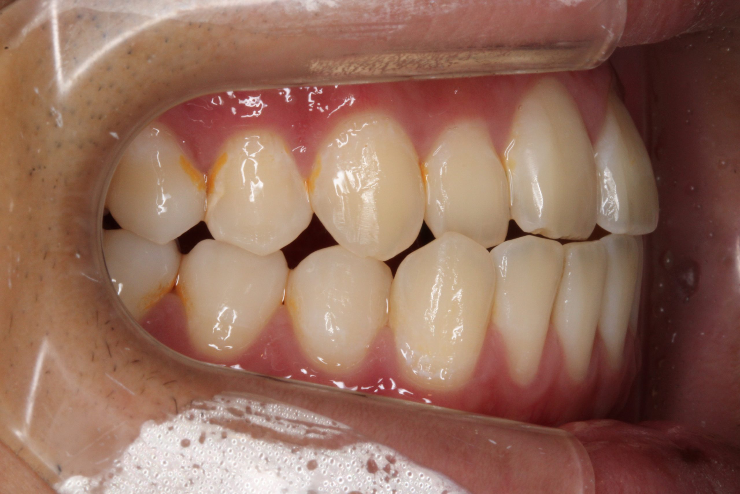 クロスバイト・裏側矯正の症例