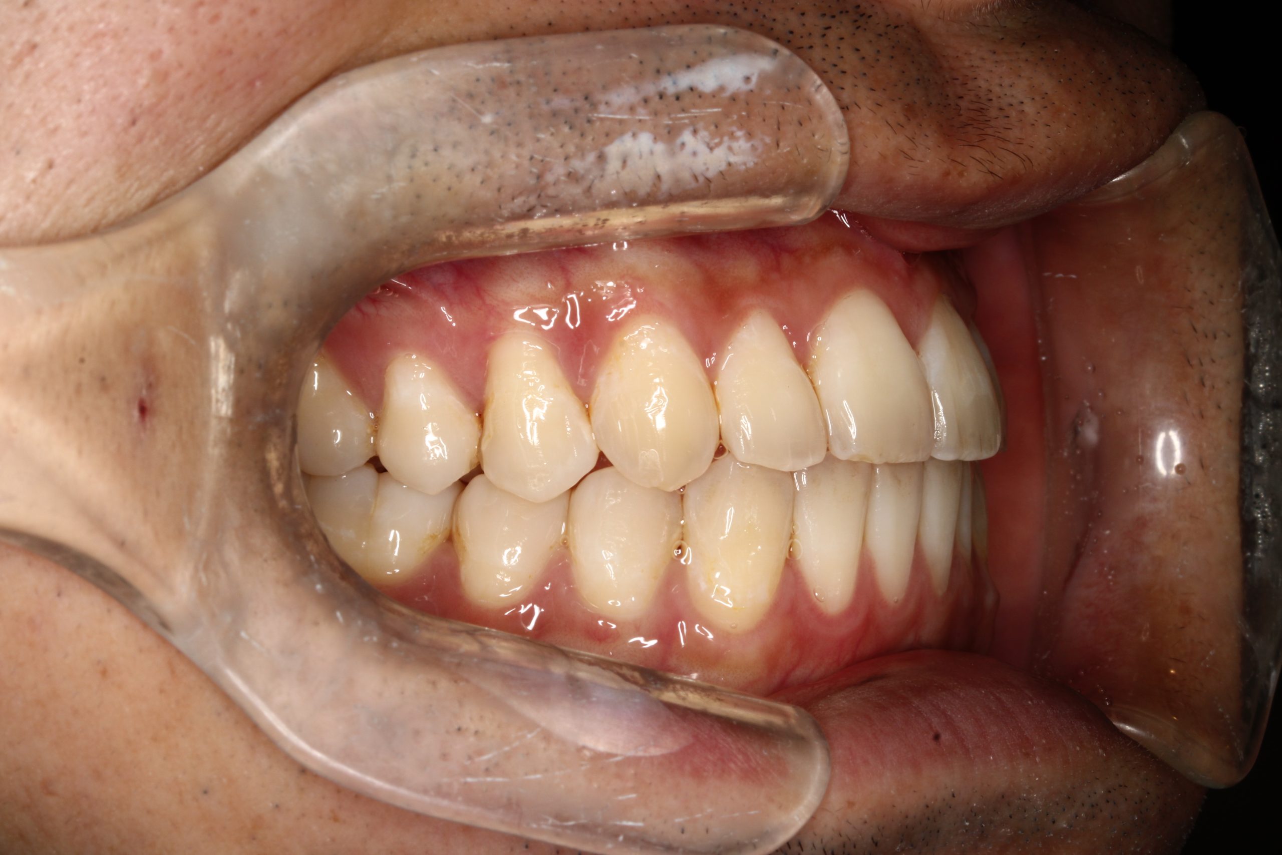 クロスバイト・裏側矯正の症例