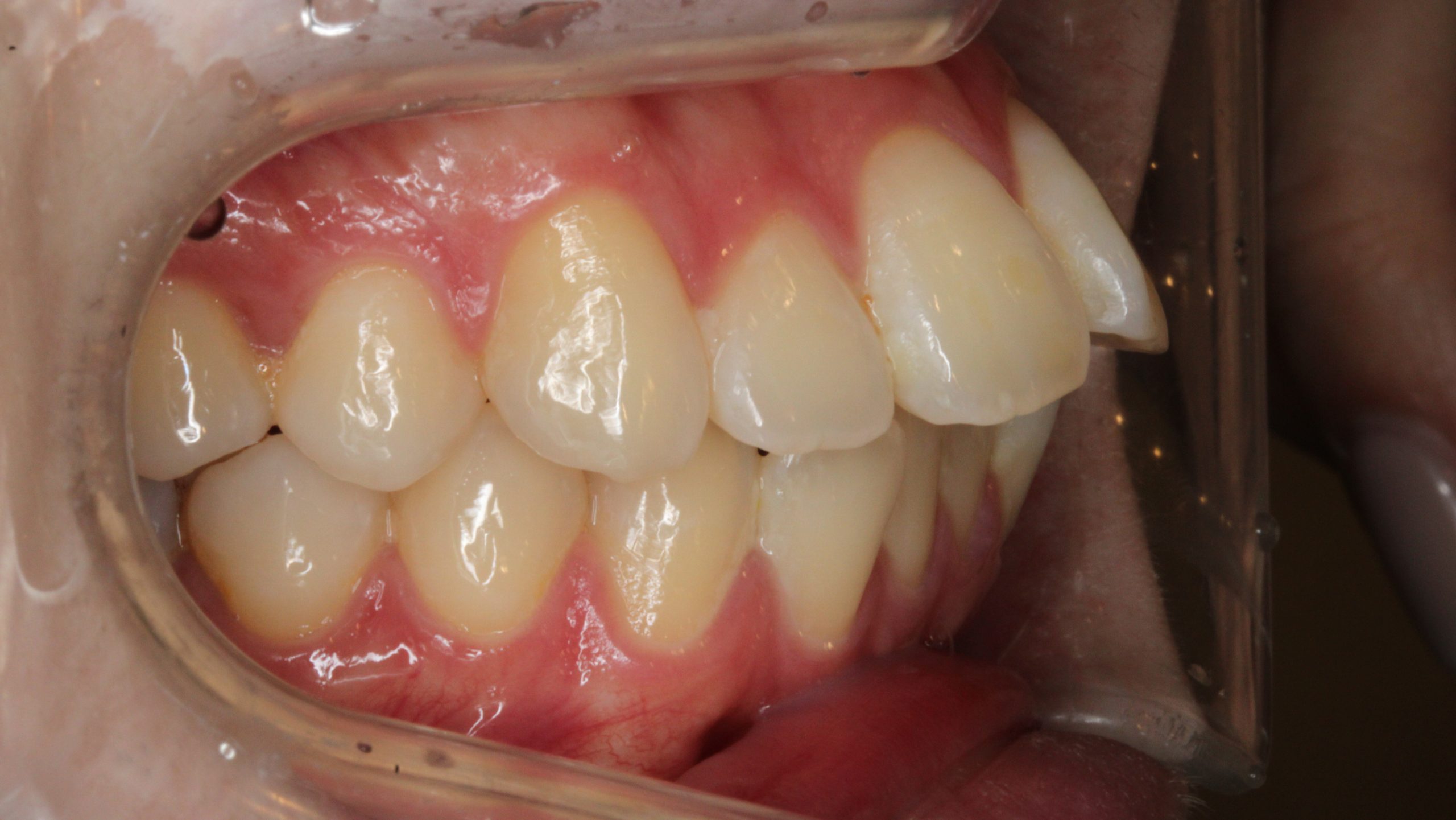 上顎前突・前歯の凸凹・リンガルの症例