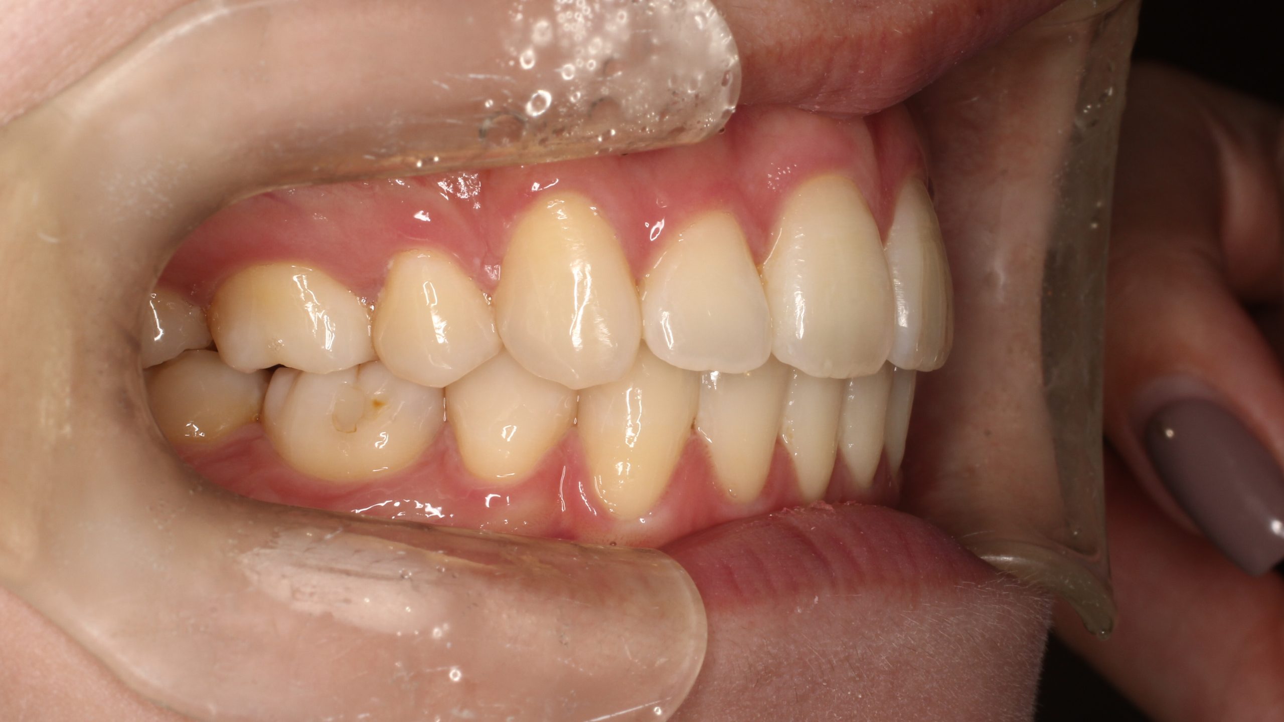 上顎前突・前歯の凸凹・リンガルの症例