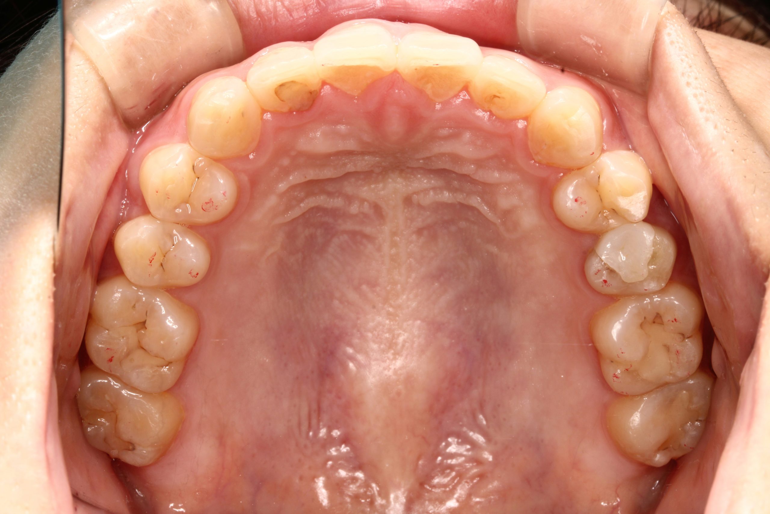 前歯のガタツキ・リンガルの症例