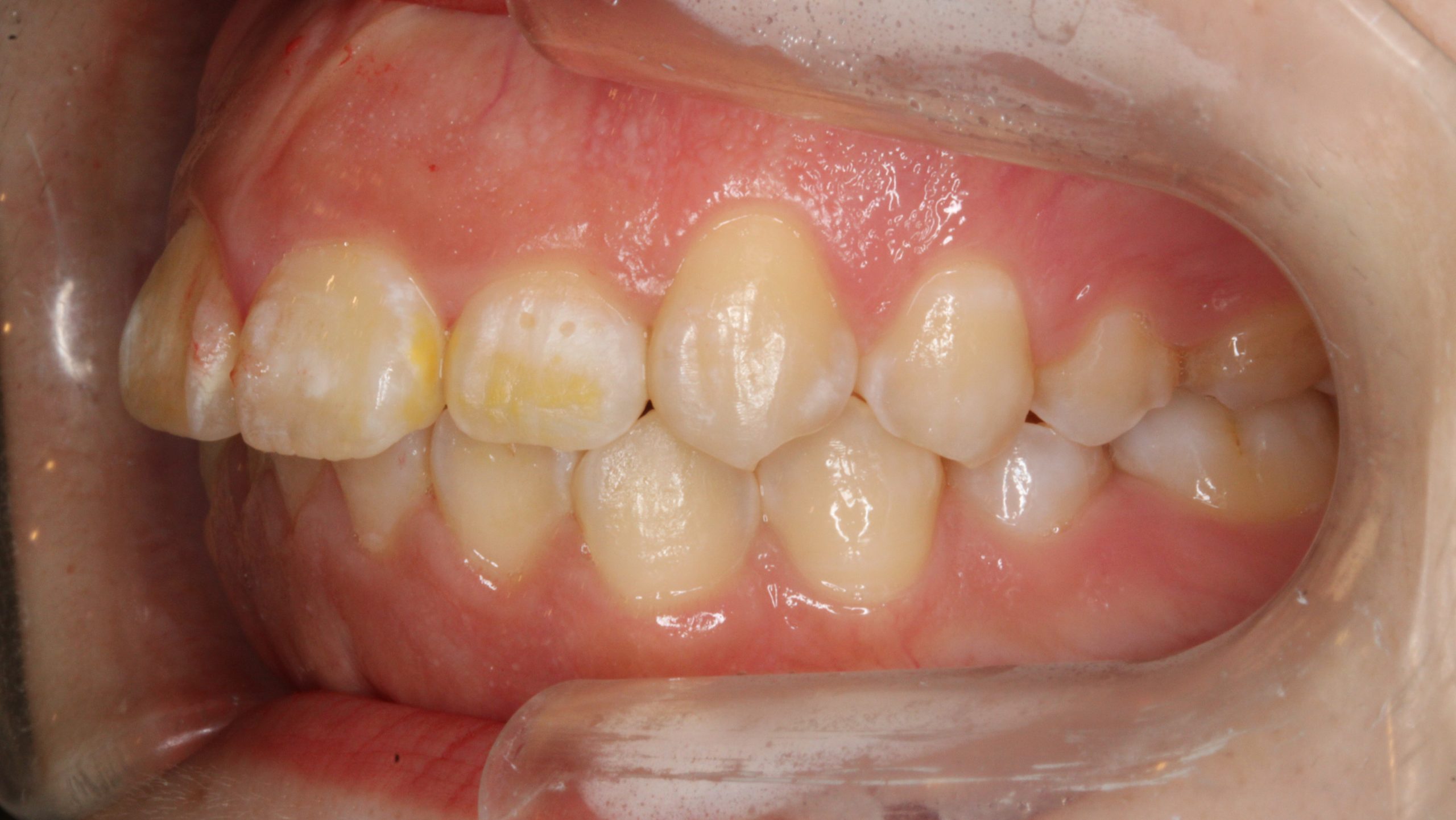 上顎前突・ハーフリンガルの症例