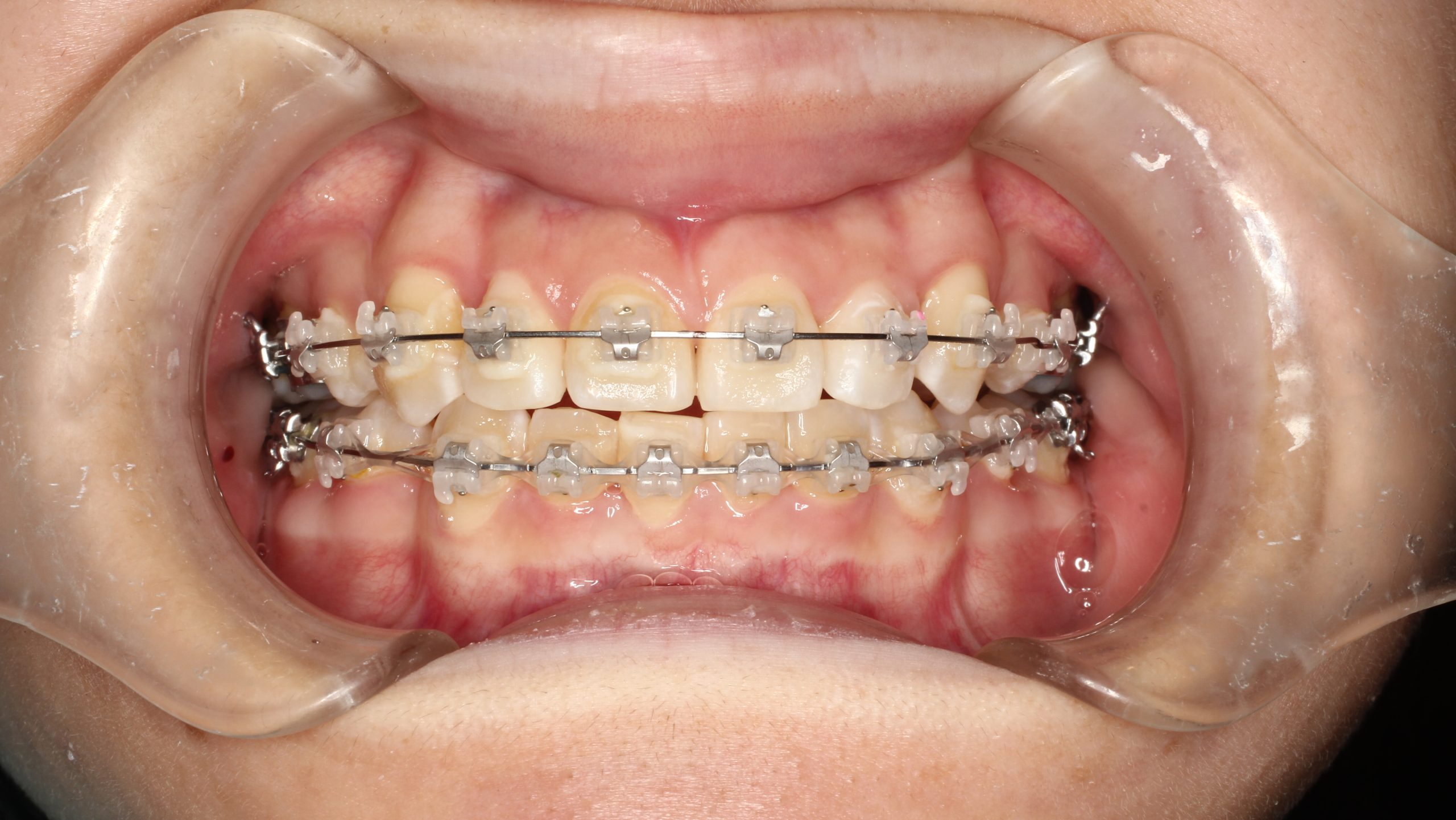 叢生・嚙み合わせ合わない・八重歯・表側矯正の症例