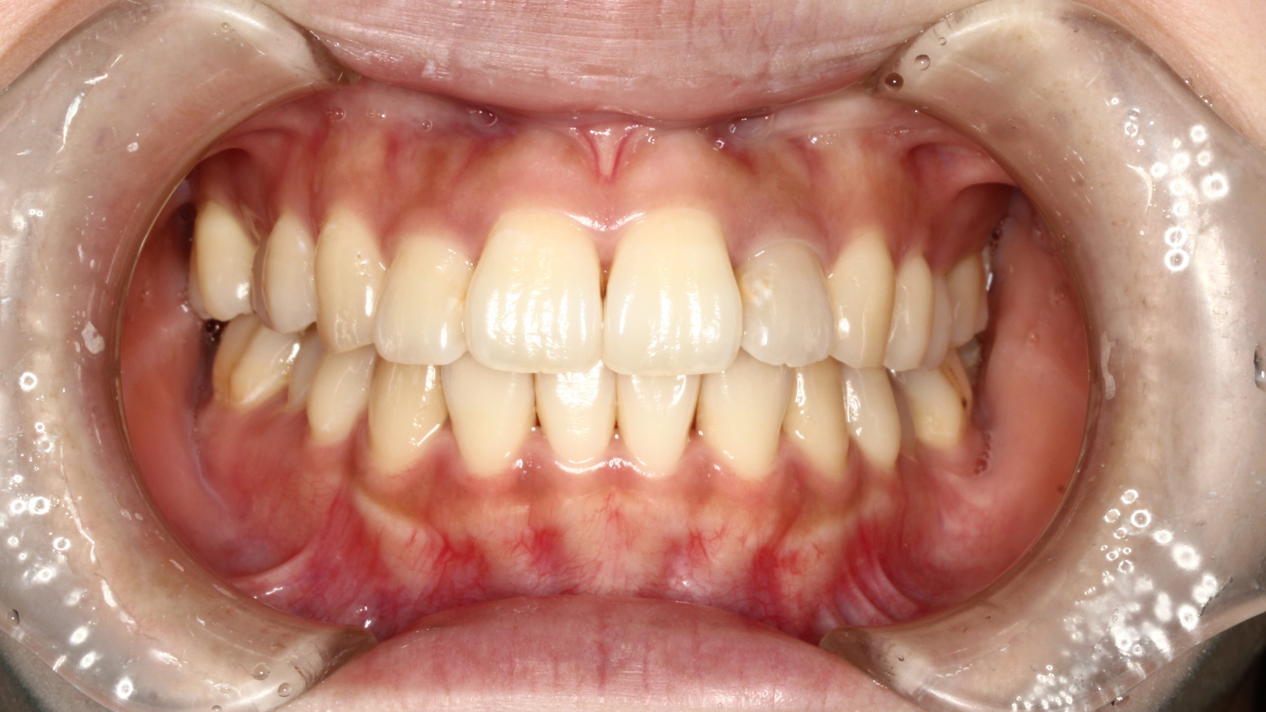 前歯の凸凹・裏側矯正・部分矯正の症例