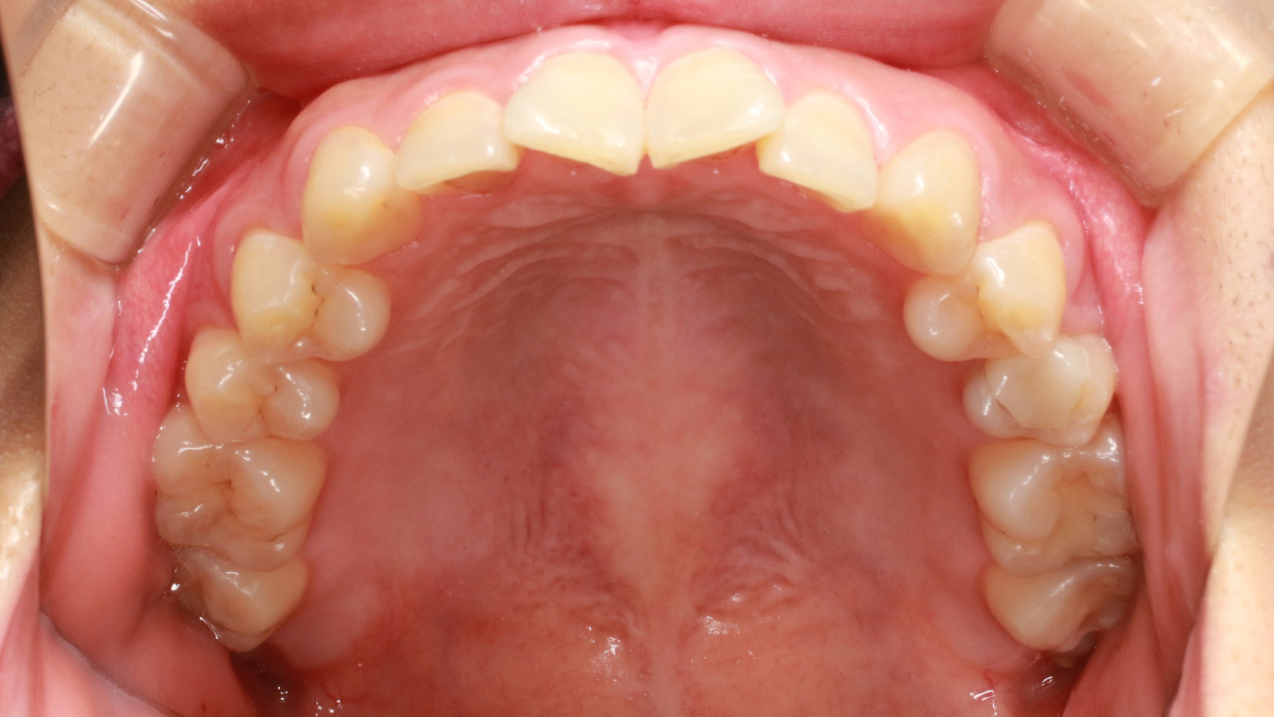 前歯のガタツキ・リンガルの症例