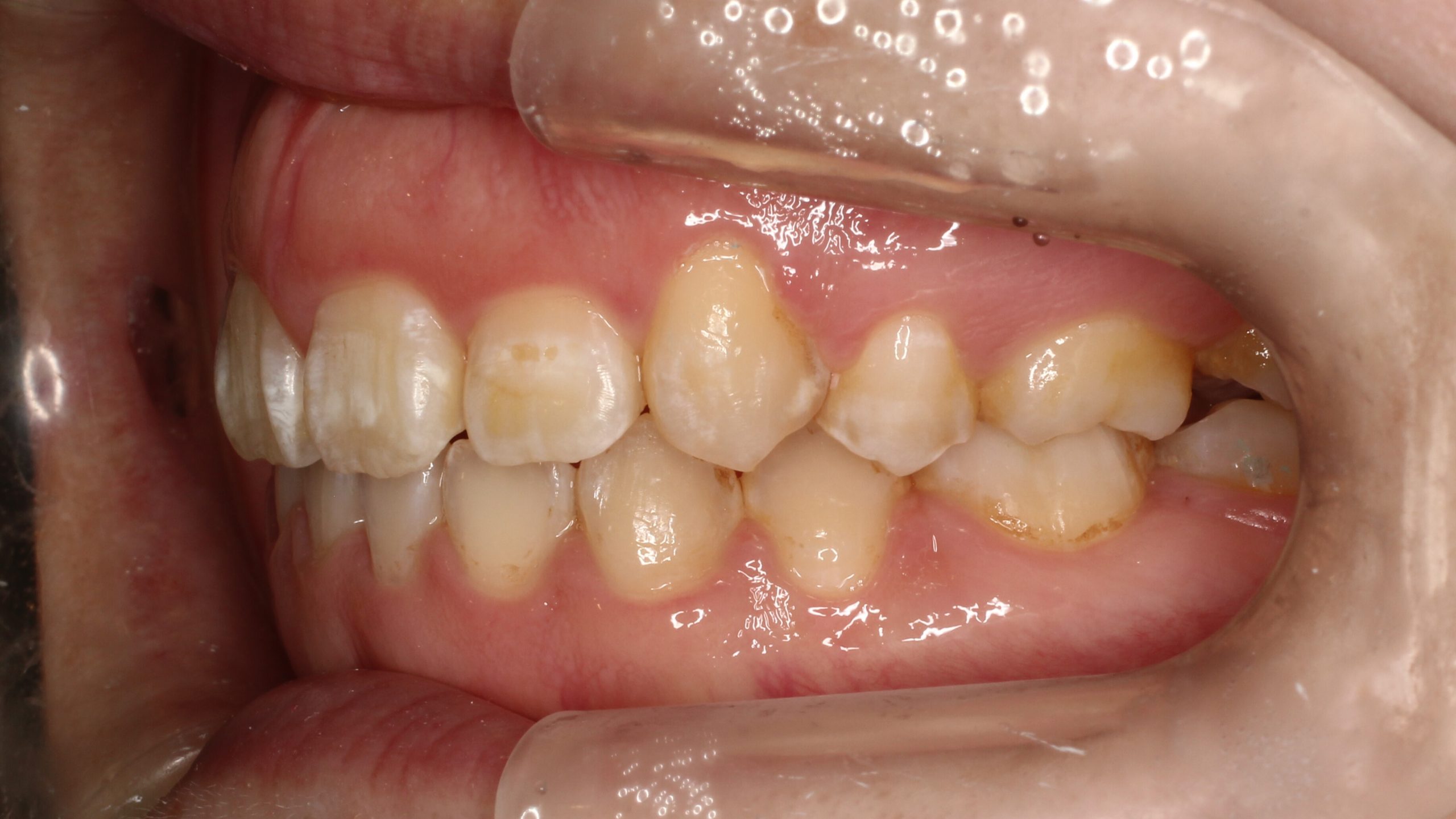 上顎前突・ハーフリンガルの症例